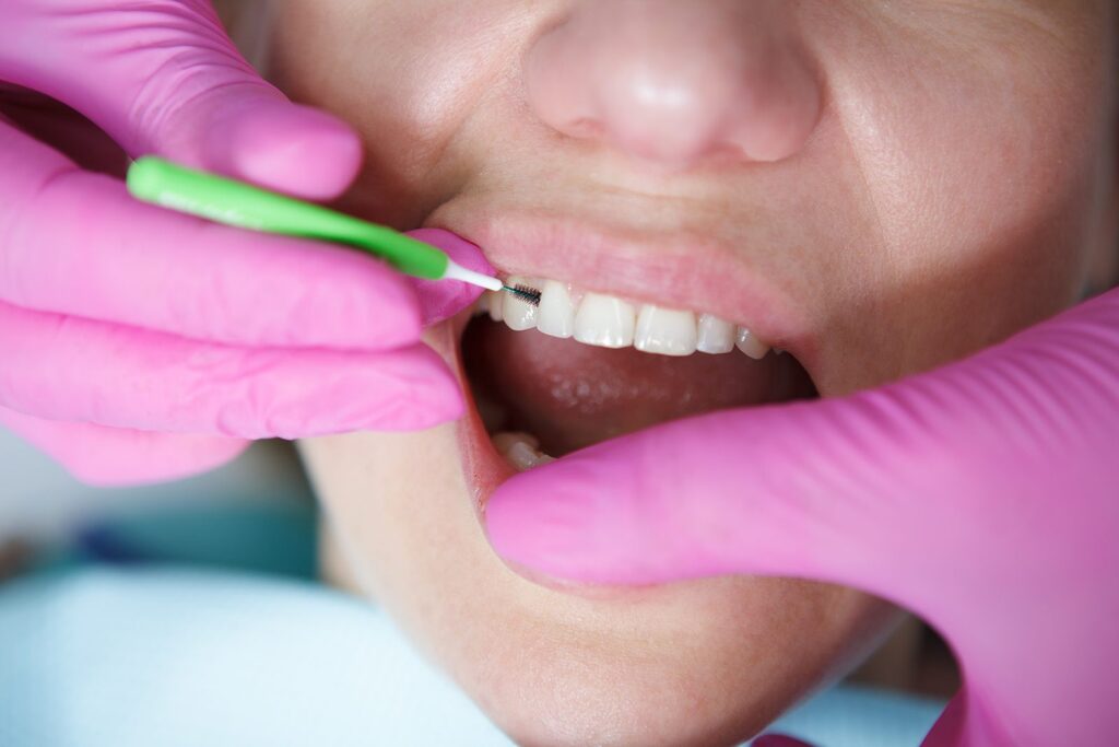 Interdentalbürste im Zahnzwischenraum Hände in rosa Handschuhen führen eine grüne Interdentalbürste in einen Zahnzwischenraum im Oberkiefer einer Patientin